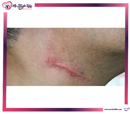 أسباب الكيس الدهني