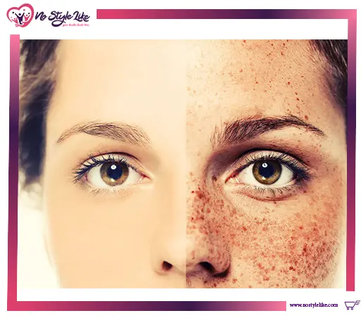 صورة توضح نتائج علاج النمش قبل وبعد