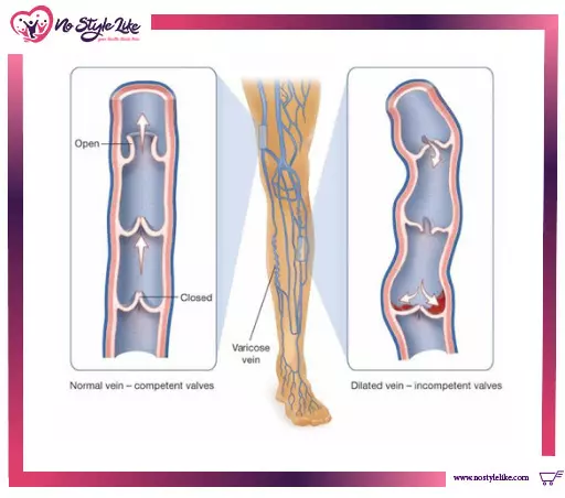 دوالي الساقين وما تسببه من مشاكل وطرق الوقاية والعلاج