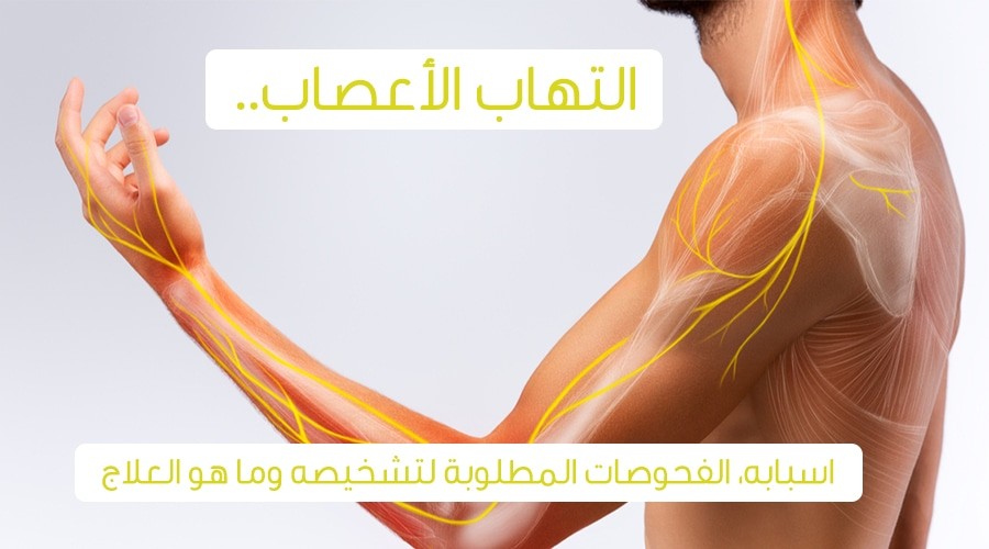 علاج التهاب الأعصاب