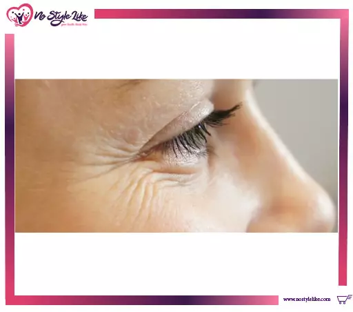 أسباب تجاعيد العين