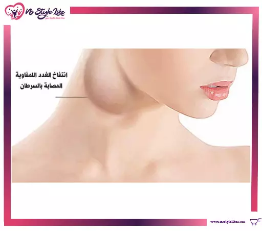 اعراض مرض الورم الليمفوي وماهي اسبابه وكيفية علاجه