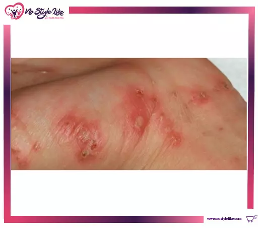 أسباب الجرب Scabies
