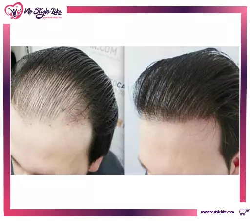 عمليات زراعة الشعر والتخلص من المناطق الخالية بالرأس