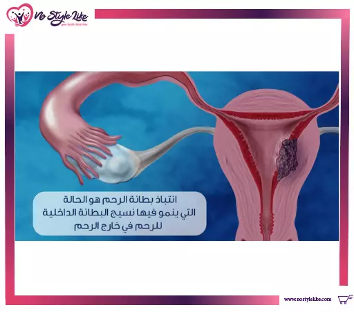 بطانة الرحم المهاجرة وتـأثيرها على تأخر الإنجاب