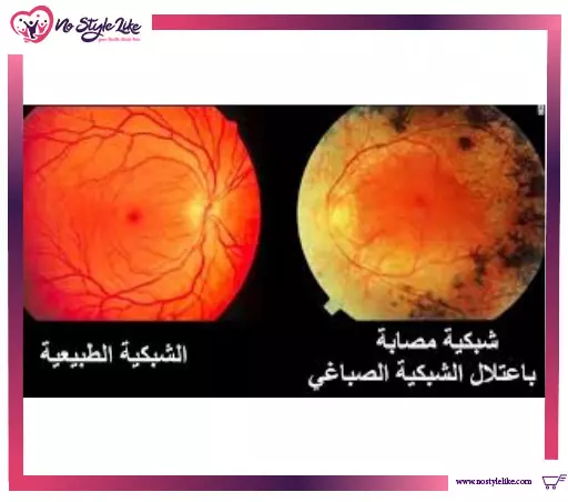 ما هو التهاب الشبكية الصباغي ؟ وما هى أعراضه وطرق علاجه ؟