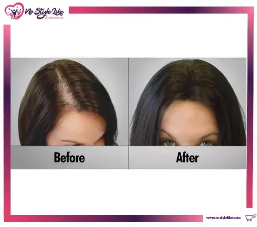 FOLTENE WOMEN SHAMPOO شامبو للنساء لعلاج الشعر الخفيف