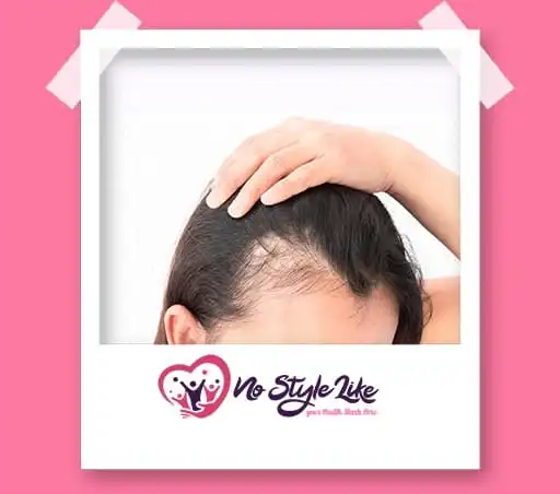 الصلع الوراثي عند النساء وكيفية التغلب عليه نهائياً ؟