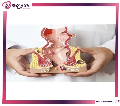 أسباب حدوث البواسير وعلاجه بالمنزل