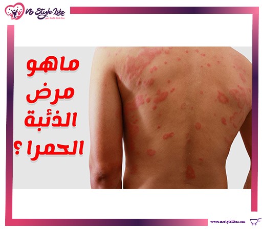 ما هو مرض الذئبة الحمراء أو الحمامية ؟ وكيفية علاجه ؟