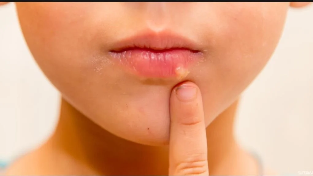 أسباب الهربس الفموي وطرق انتقال العدوى عبر اللعاب