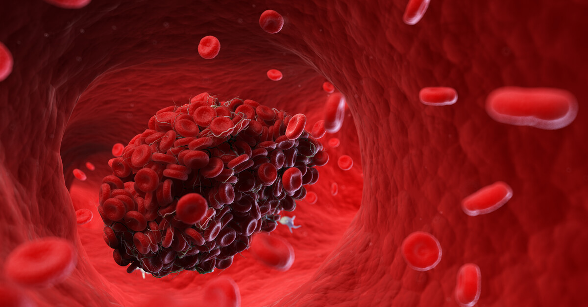 تخثر الدم داخل الأوعية الدموية