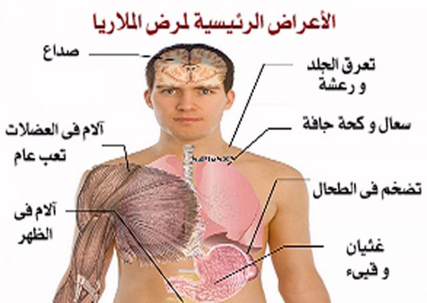 اعراض مرض الملاريا وأشهر العلامات مثل الحمى والقشعريرة والتعرّق