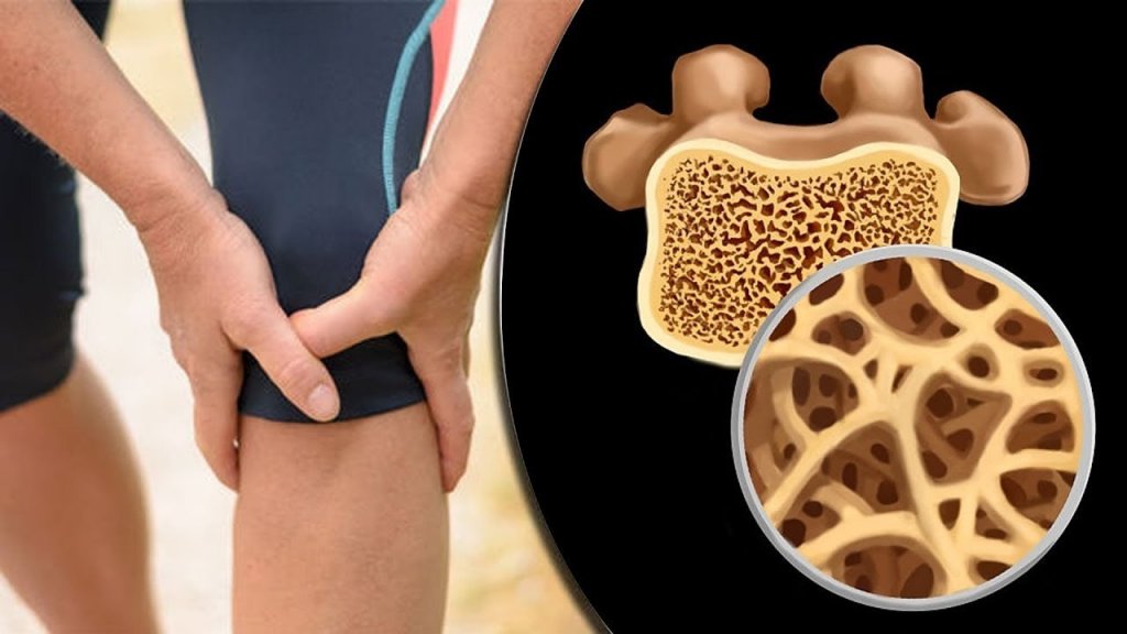 مرض هشاشة العظام وأسبابه وأعراضه والعلاج الأمثل والفعال