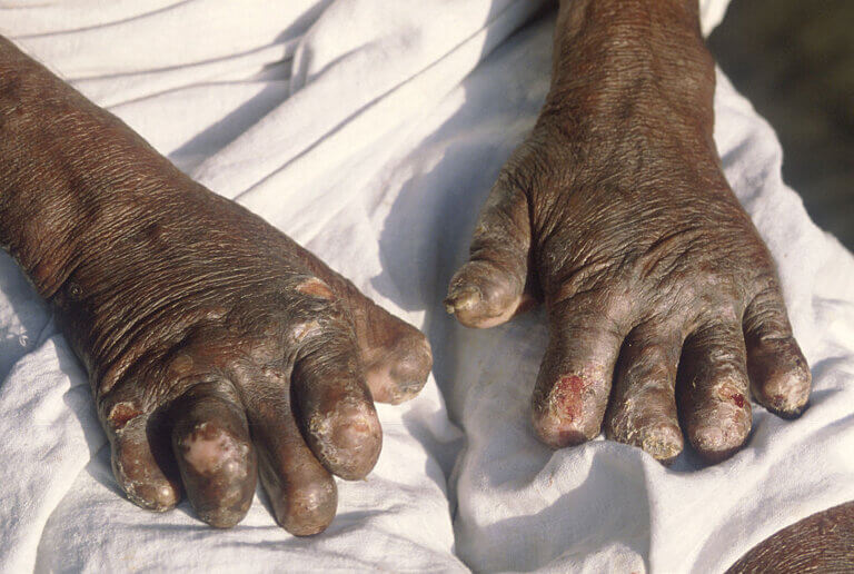 أسباب الجذام Leprosy