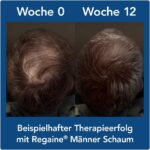 ⁦Regaine Männer Schaum 5 mg مينوكسيديل لعلاج تساقط الشعر⁩ - الصورة ⁦3⁩