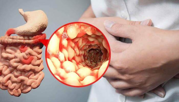 أسباب داء كرون