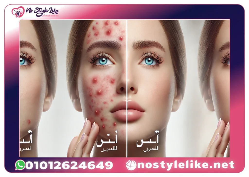 Diane 35 مكمل لتنظيم الهرمونات