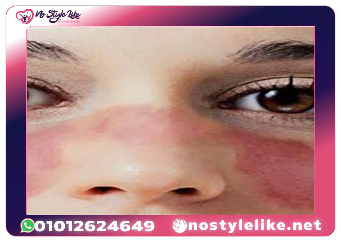 دواء benlysta 200mg لعلاج المناعة الذاتية