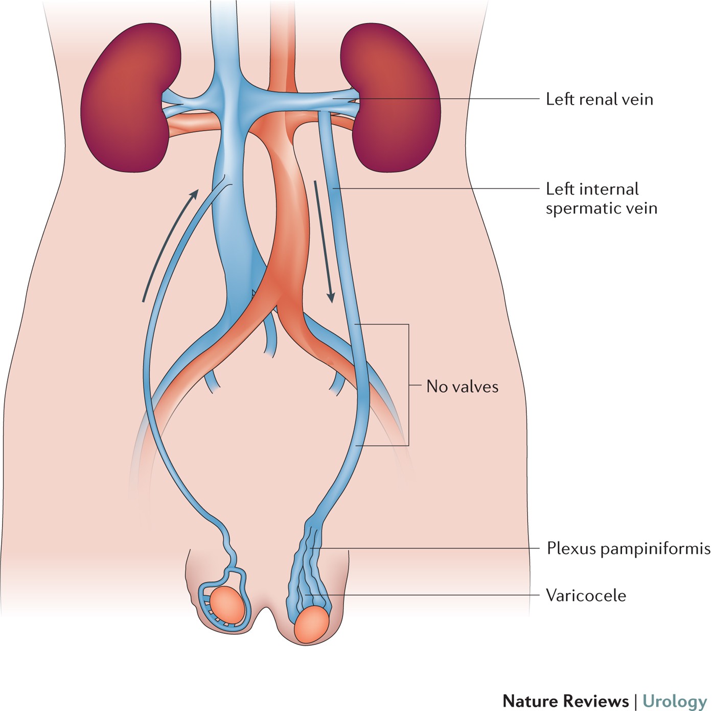 دوالي الخصية