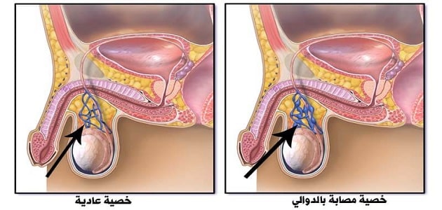 دوالي الخصية