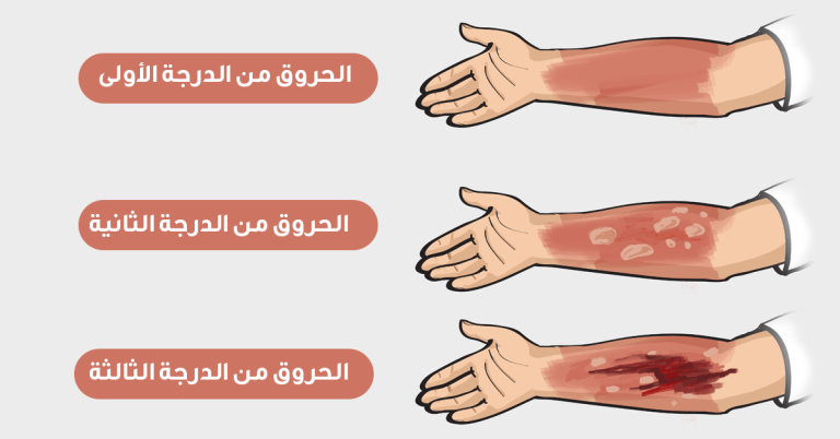 أسباب الحروق Burns