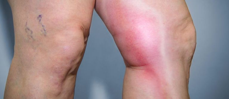 ما هو تجلط الأوردة العميقة (DVT)؟ وكيف يمكن علاجه؟