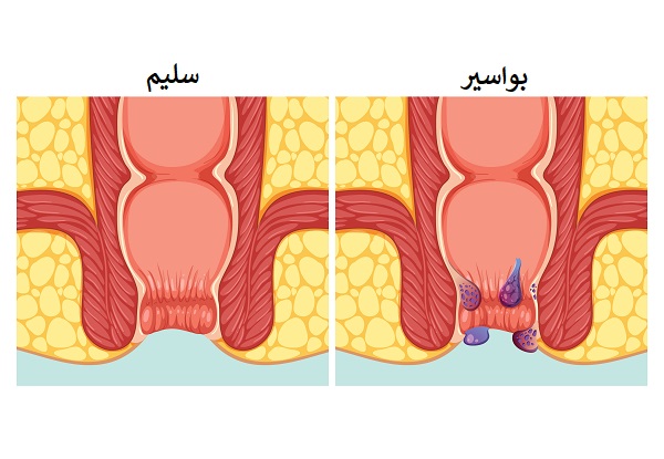 أسباب البواسير Hemorrhoid