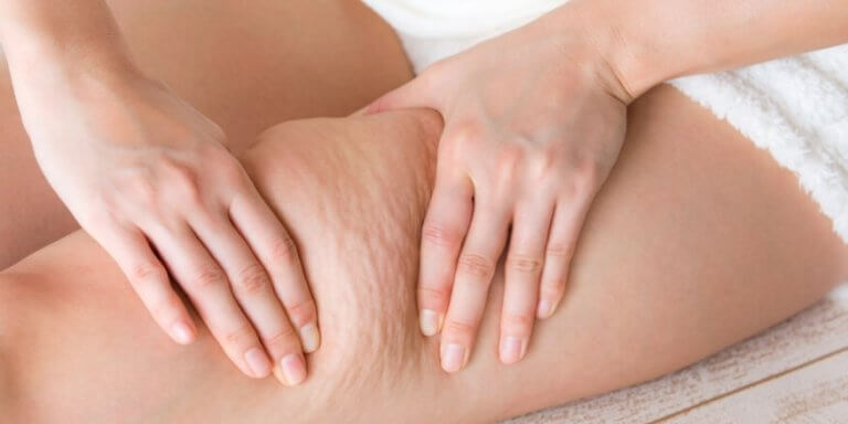 أسباب السيلوليت Cellulite