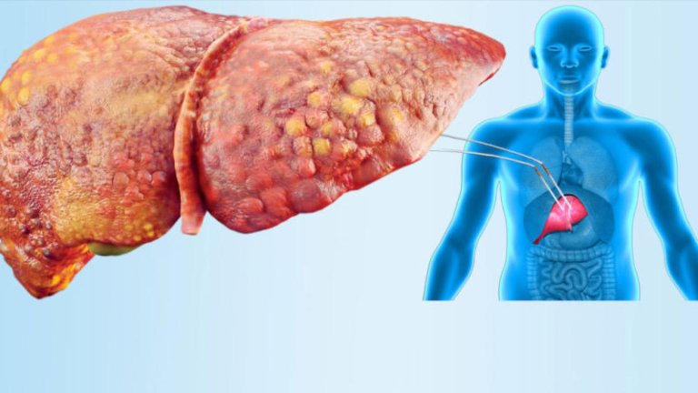 أعراض الكبد الدهني وتأثير الدهون على الكبد