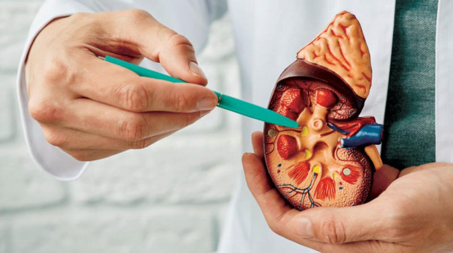 أسباب حصوات الكلى