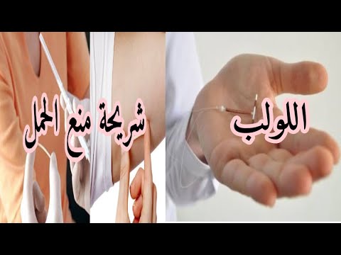 شريحة منع الحمل ( اللولب الهرموني) مزاياه وعيوبه