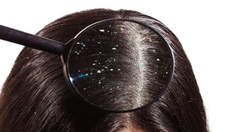 أسباب القشرة Dandruff