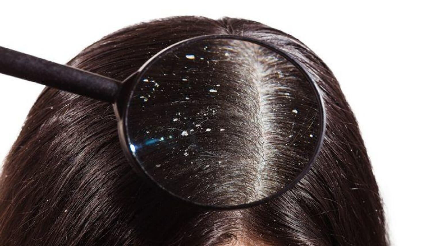 أسباب القشرة Dandruff