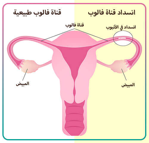 إنسداد قناة فالوب