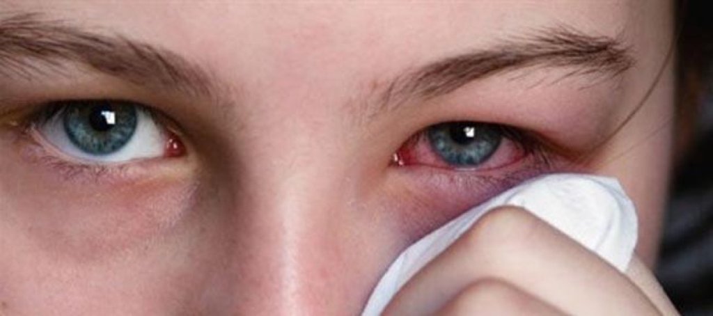  أسباب الرمد Ophthalmia