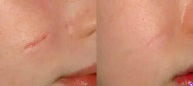 علاج آثار الجروح والخدوش