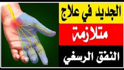 متلازمة النفق الرسغي