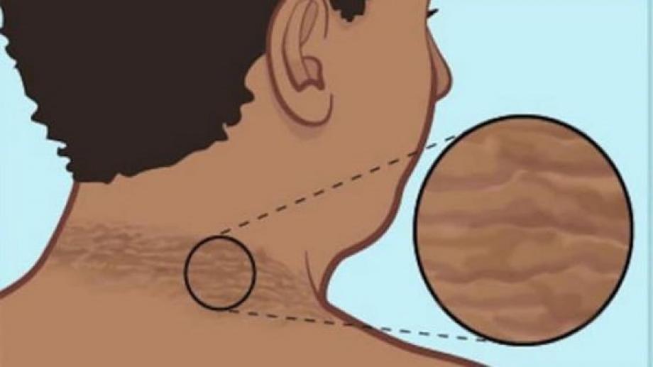 أسباب الشواك الأسود