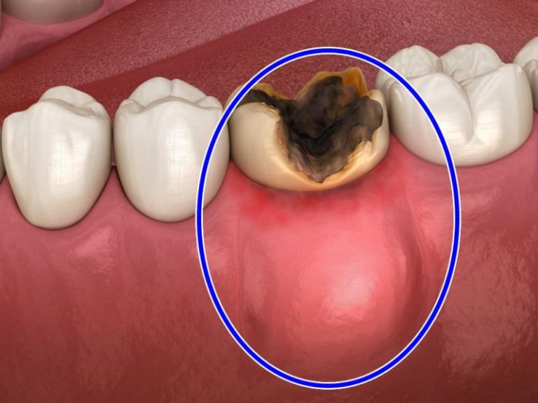 أعراض خراج الأسنان