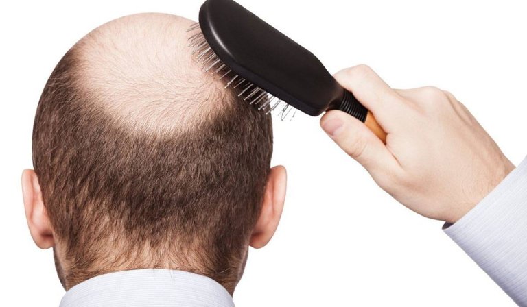 تساقط الشعر وأسبابه الشائعة