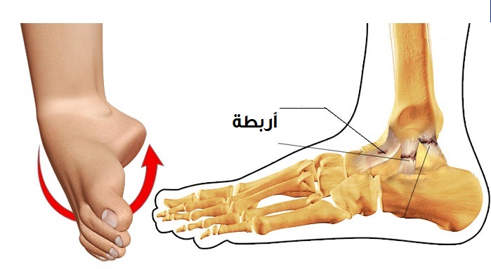 أسباب تمزق الأربطة