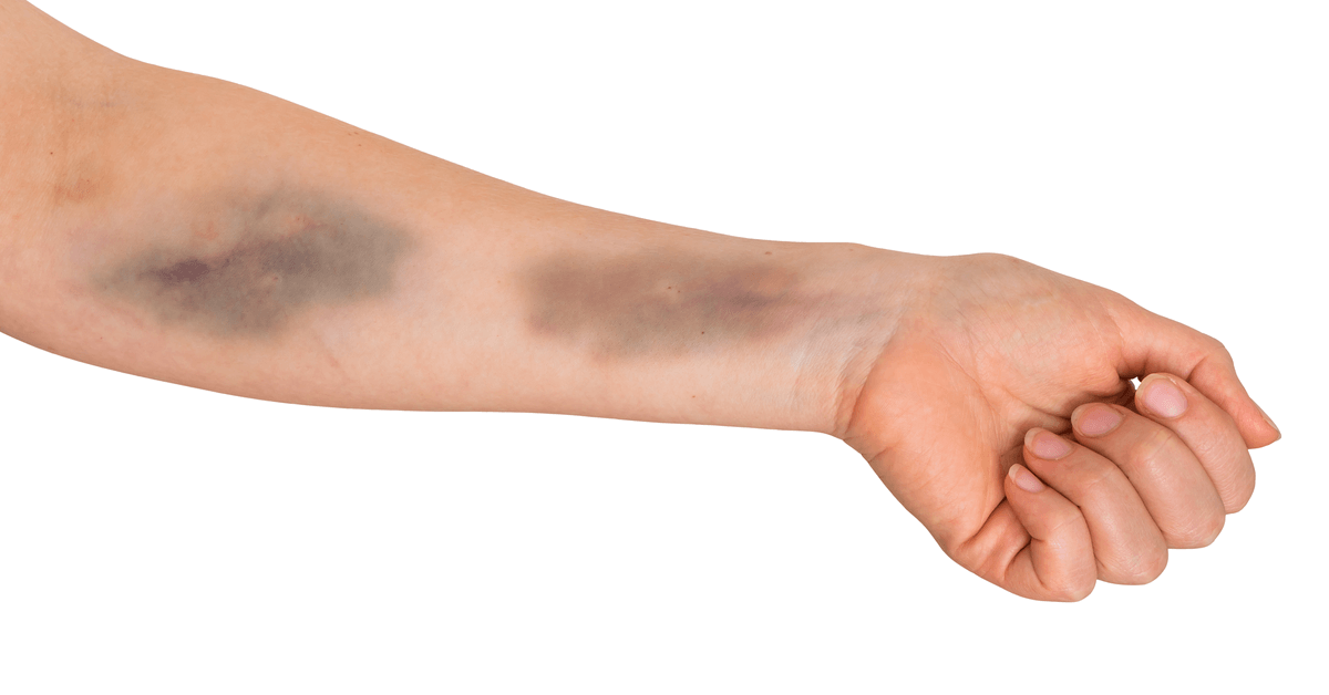 أسباب الكدمات Bruise