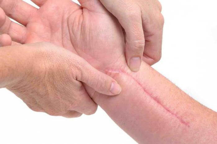 أسباب الندبات Scars