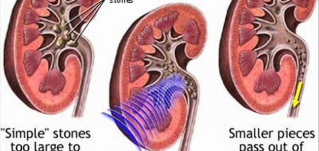 أسباب تضخم الكلى