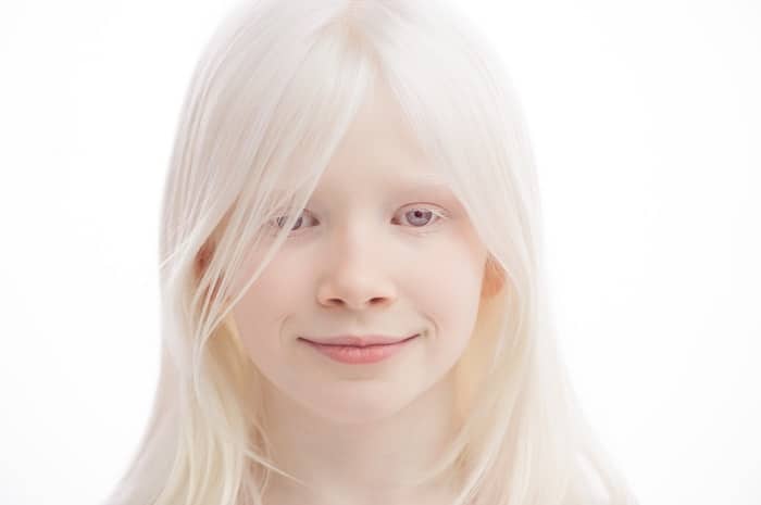 أسباب المهق Albinism