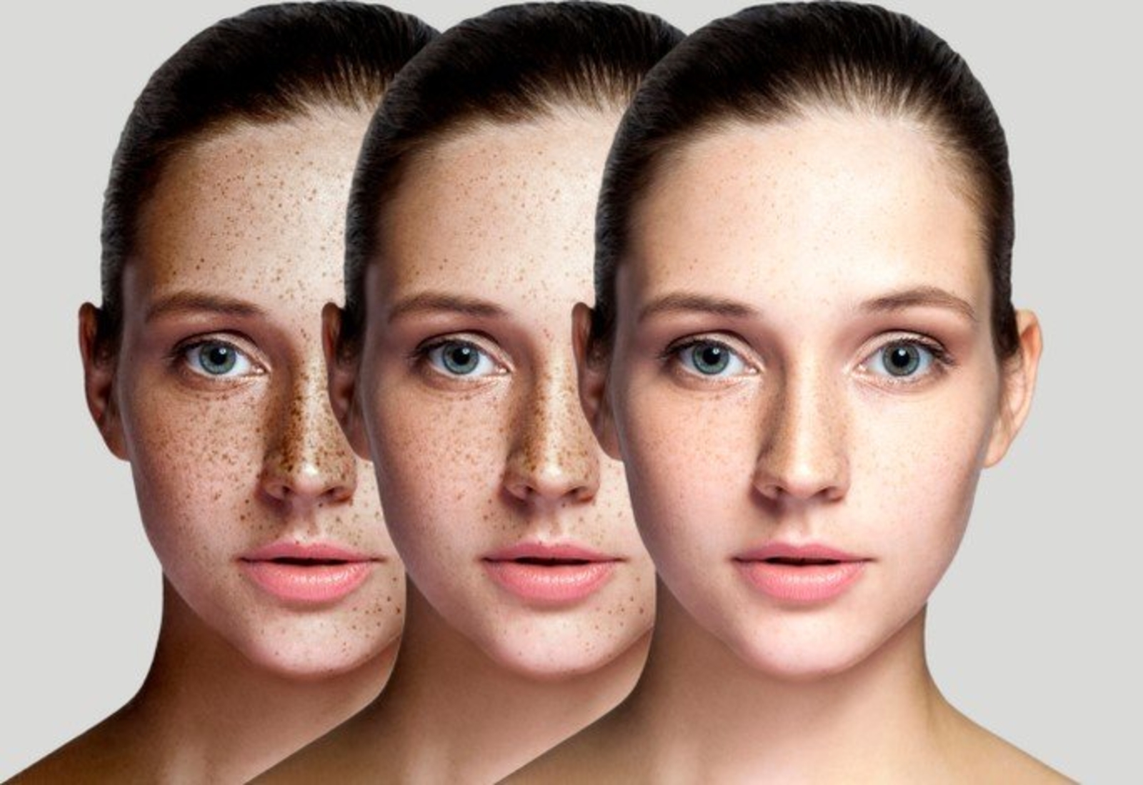 أسباب النمش Freckle