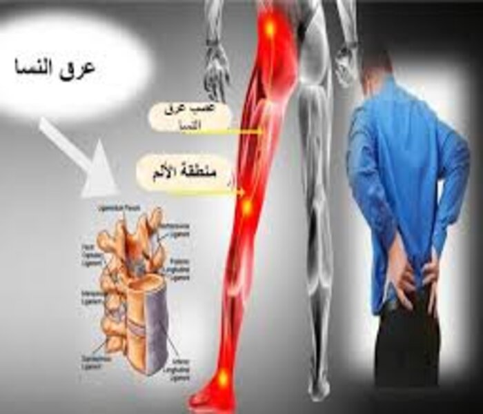 اسباب عرق النسا