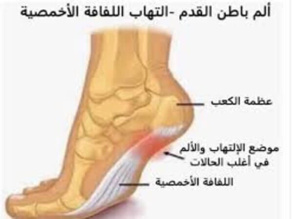 طرق علاج التهاب اللفافة الأخمصية