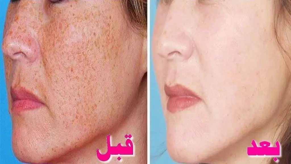 علاج الكلف والنمش